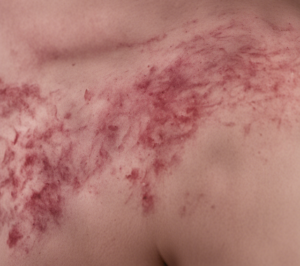 Shoulder of a patient with SLE